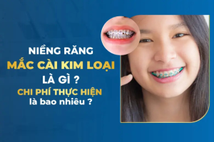 KIẾN THỨC NIỀNG RĂNG