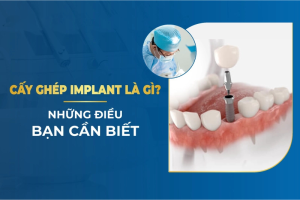 KIẾN THỨC TRỒNG RĂNG IMPLANT